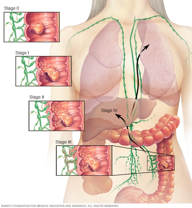 Illustration Showing Colon Cancer Stages illustration-showing-colon-cancer-stages